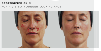 lpg face lift