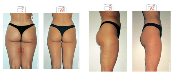 liposuction