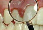 bad gums