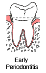 Early Periodontitis