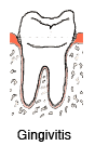 Gingivitis